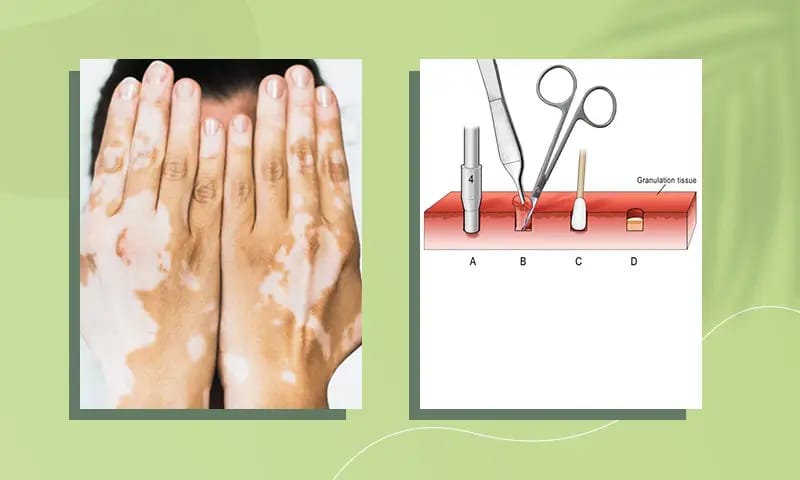 Vitiligo Surgery Treatment